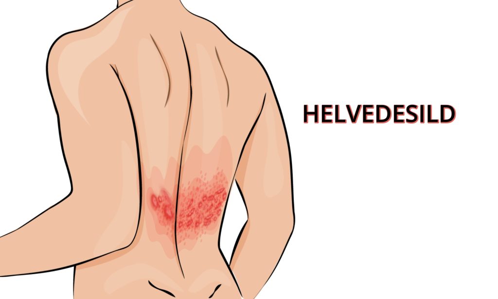 tegning af helvedesild - herpes zoster - information og billeder