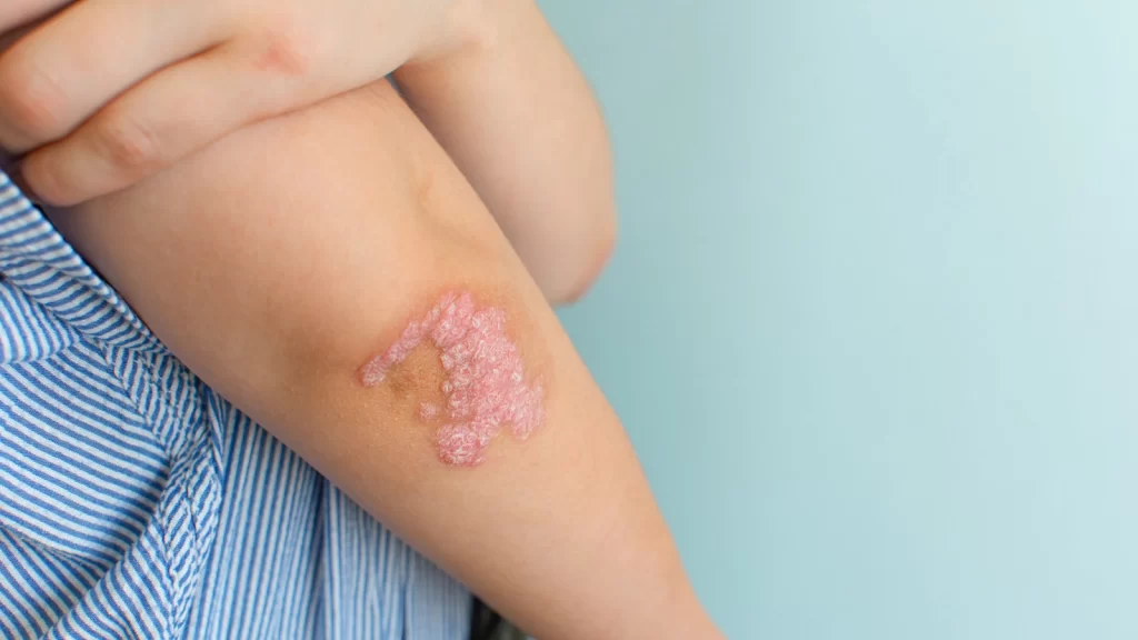 psoriasis